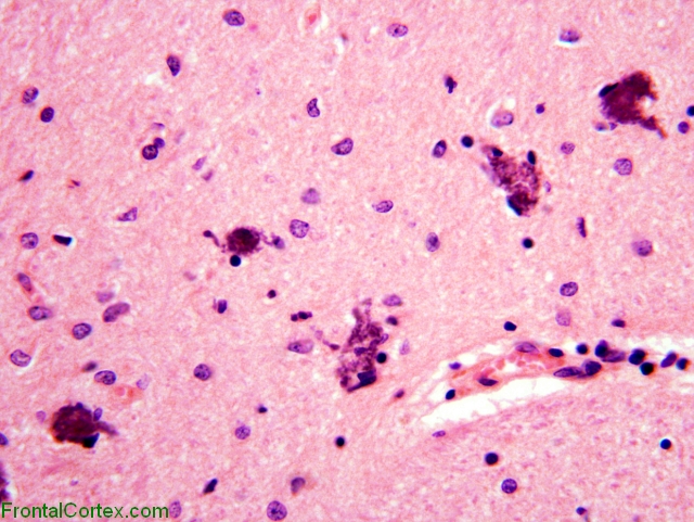 Neuronal mineralization, thalamic neurons, H&E stain